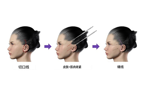 拉皮手术模拟图