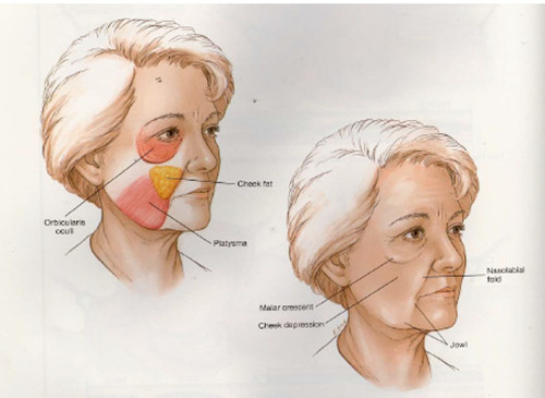 面部组织下垂图示