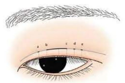 双眼皮修复手术卡通展示图