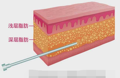 吸脂深层脂肪浅层脂肪漫画图