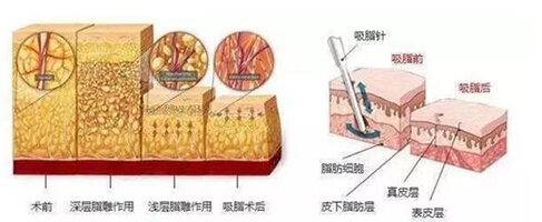 吸脂原理漫画示意图