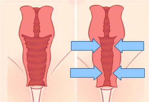 女性阴道松弛和紧致对比