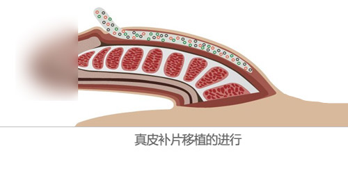 男性增粗生物补片