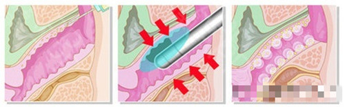 菲蜜丽激光阴道紧缩术图示