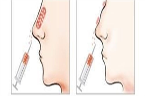 鼻部不同部位注射图