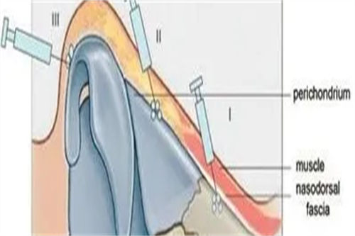 鼻部注射部位图