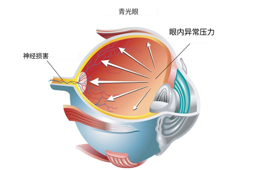 青光眼球内部示意图