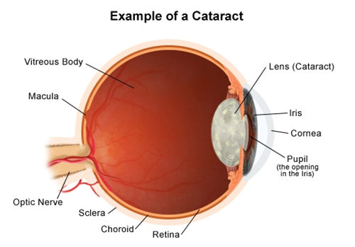 白内障眼球图示