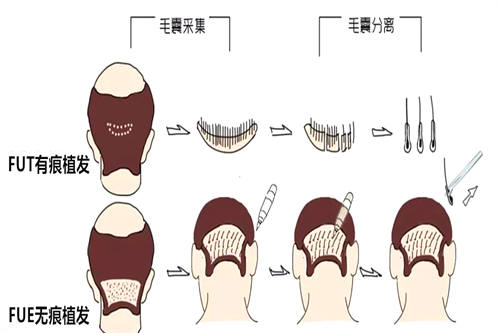 不同类型植发对比图