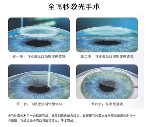 全飞秒治疗近视图示