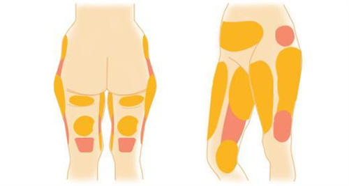 脂肪分布图示意图