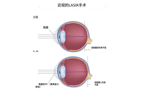 近视眼手术视线前后对比图