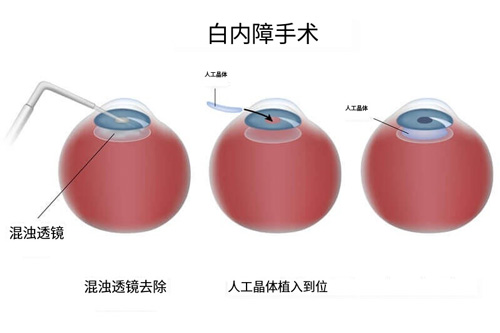 白内障手术示意图