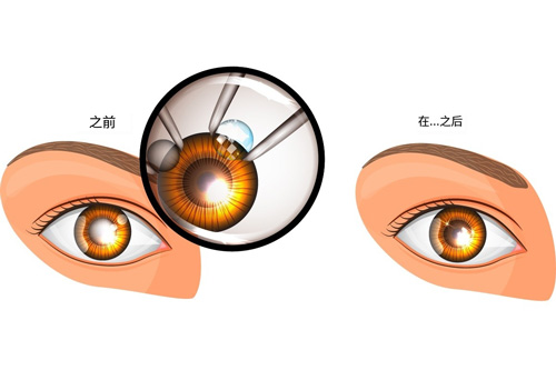 白内障手术治疗对比图