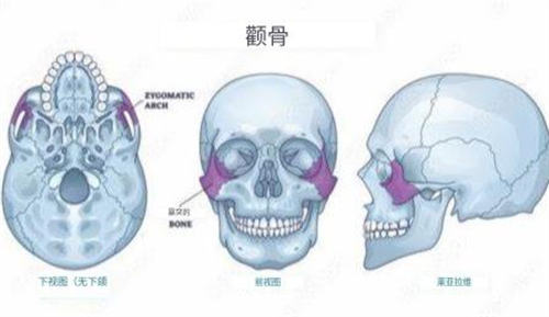 颧骨内推模型