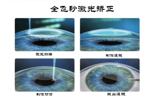 全飞秒激光矫正示意图