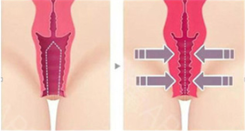 阴道缩紧对比示意图
