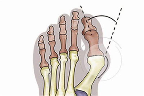 大脚骨问题