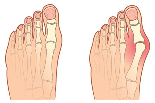 正常脚和大脚骨