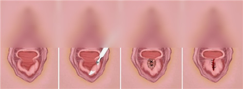 处女膜手术修复差异