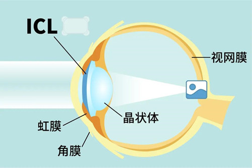 ICL晶体植入位置