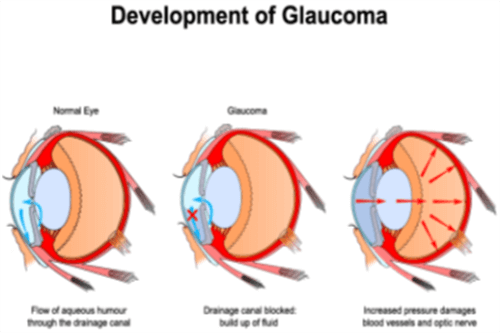 青光眼的形成