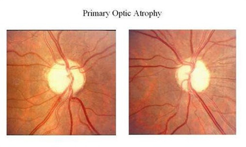 视神经萎缩的眼底