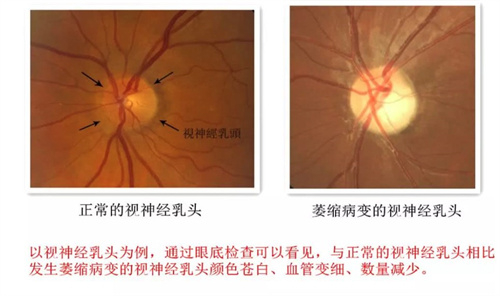 视神经萎缩对比