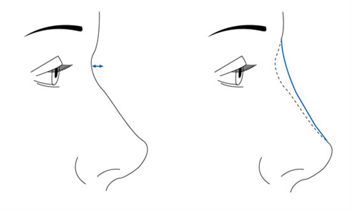 隆鼻手术前后对比