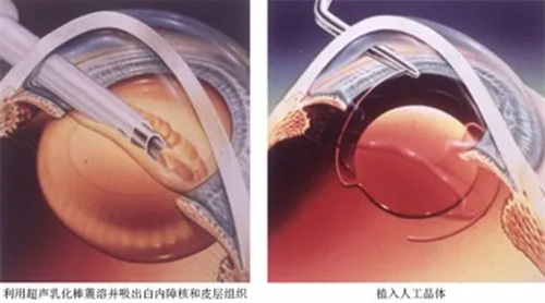 深圳白内障患者必看!深圳白内障手术免费政策全方面解读,助你重见光明!