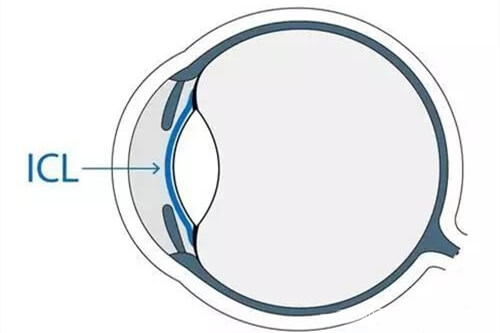 ICL晶体植入近视眼手术眼球位置示意图