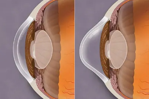 圆锥角膜对比