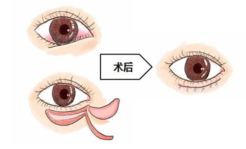 倒睫手术怎么做的