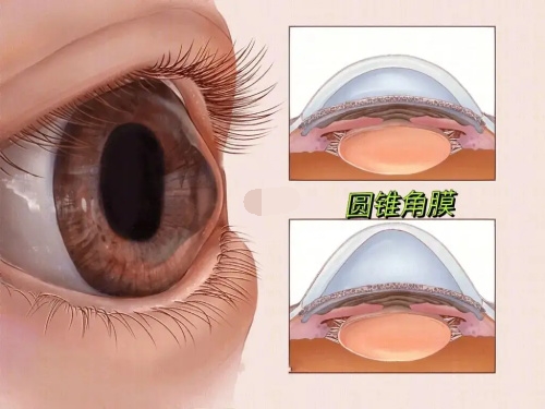 圆锥角膜的角膜状态