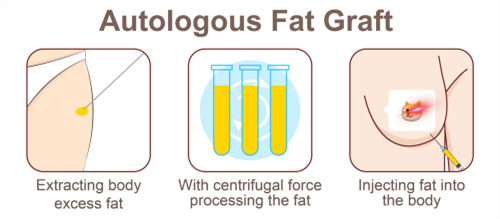 自体脂肪隆胸