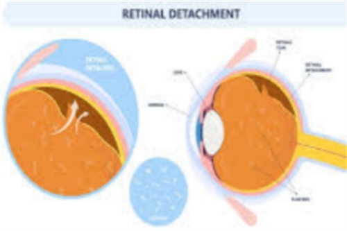 视网膜脱离图示