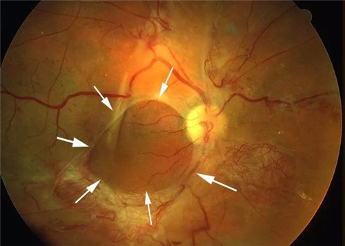 视网膜脱落细节表现图