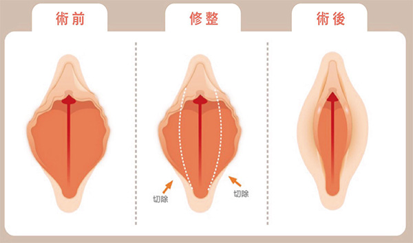 外阴唇切除术前术后