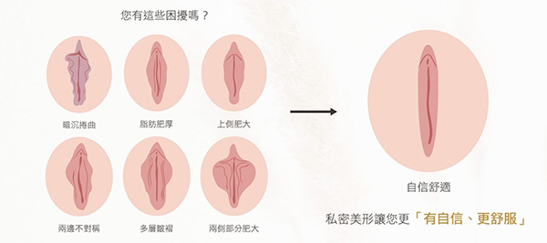 外阴阴唇整形前后变化